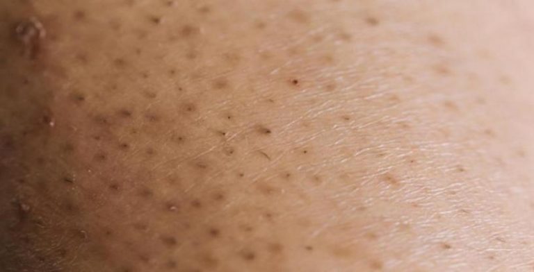 what-causes-ingrown-leg-hairs-and-how-to-prevent-them