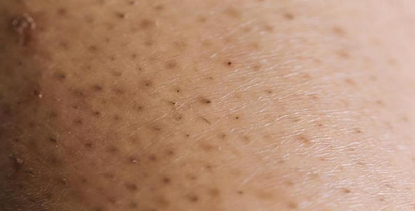 What Causes Ingrown Leg Hairs And How To Prevent Them