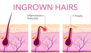 What Causes Ingrown Leg Hairs and How to Prevent Them