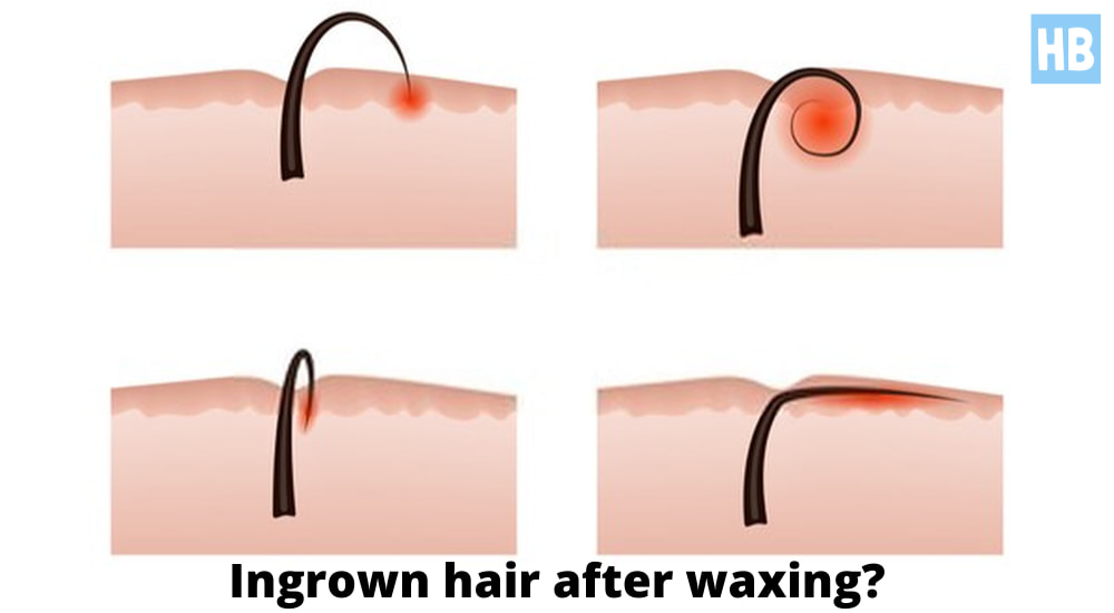 Oh No Bad Ingrown Hairs After Brazilian Wax What To Do