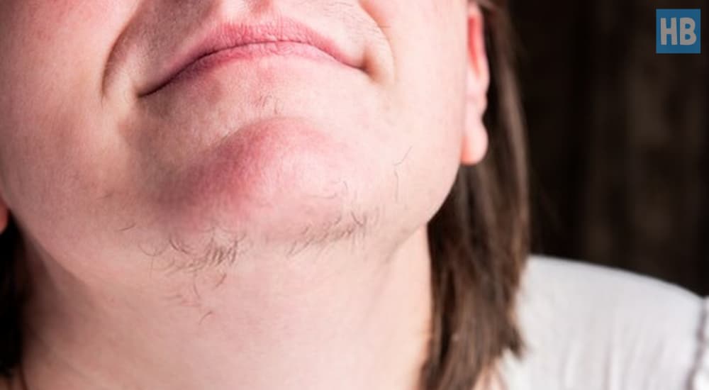 a-lowdown-on-how-to-get-rid-of-chin-hair-permanently